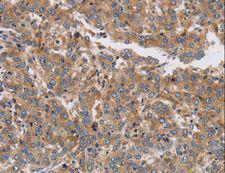 K13 / KCNG Antibody - Immunohistochemistry of paraffin-embedded Human colon cancer using KCNG1 Polyclonal Antibody at dilution of 1:40.