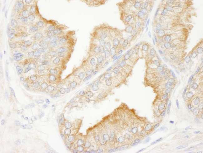 KANK2 Antibody - Detection of Human KANK2/SIP by Immunohistochemistry. Sample: FFPE section of human prostate carcinoma. Antibody: Affinity purified rabbit anti-KANK2/SIP used at a dilution of 1:250.