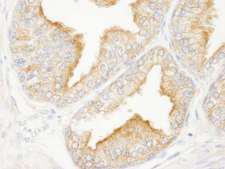 KANK2 Antibody - Detection of Human KANK2/SIP by Immunohistochemistry. Sample: FFPE section of human prostate carcinoma. Antibody: Affinity purified rabbit anti-KANK2/SIP used at a dilution of 1:250.