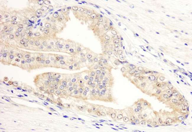 KANK2 Antibody - Detection of Human KANK2/SIP by Immunohistochemistry. Sample: FFPE section of human prostate carcinoma. Antibody: Affinity purified rabbit anti-KANK2/SIP used at a dilution of 1:1000 (1 ug/ml). Detection: DAB.
