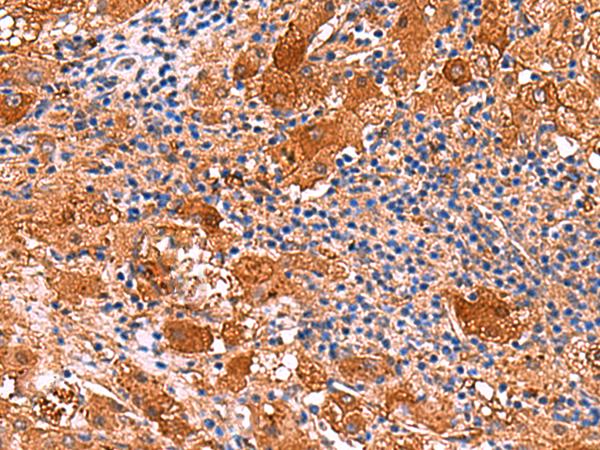 KANK3 Antibody - Immunohistochemistry of paraffin-embedded Human liver cancer tissue  using KANK3 Polyclonal Antibody at dilution of 1:50(×200)