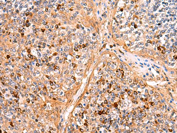 KANSL1L Antibody - Immunohistochemistry of paraffin-embedded Human liver cancer tissue  using KANSL1L Polyclonal Antibody at dilution of 1:40(×200)