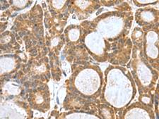 KANSL1L Antibody - Immunohistochemistry of paraffin-embedded Human thyroid cancer tissue  using KANSL1L Polyclonal Antibody at dilution of 1:80(×200)