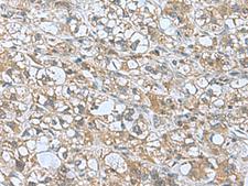 KANSL1L Antibody - Immunohistochemistry of paraffin-embedded Human liver cancer tissue  using KANSL1L Polyclonal Antibody at dilution of 1:55(×200)