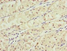 KANSL3 Antibody - Immunohistochemistry of paraffin-embedded human gastric cancer at dilution of 1:100