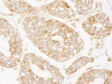 KARS Antibody - Detection of Human KARS by Immunohistochemistry. Sample: FFPE section of human breast carcinoma. Antibody: Affinity purified rabbit anti-KARS used at a dilution of 1:250. Epitope Retrieval Buffer-High pH (IHC-101J) was substituted for Epitope Retrieval Buffer-Reduced pH.