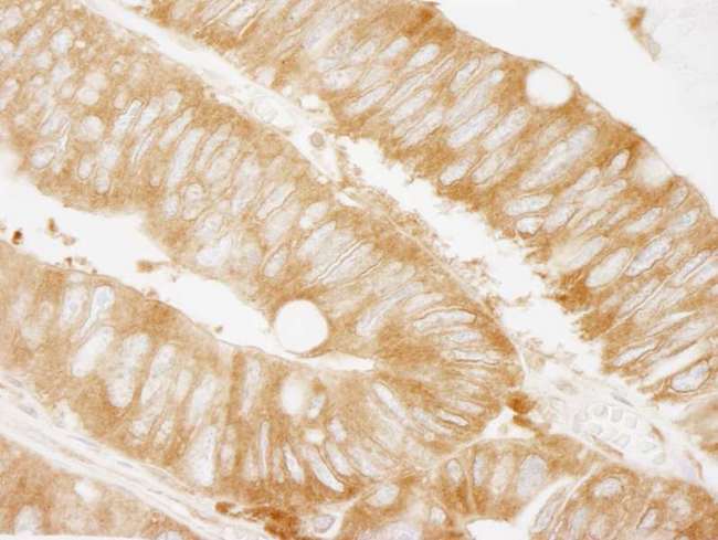 KARS Antibody - Detection of Human KARS by Immunohistochemistry. Sample: FFPE section of human colon carcinoma. Antibody: Affinity purified rabbit anti-KARS used at a dilution of 1:250. Epitope Retrieval Buffer-High pH (IHC-101J) was substituted for Epitope Retrieval Buffer-Reduced pH.