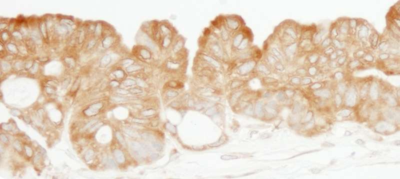 KARS Antibody - Detection of Human KARS by Immunohistochemistry. Sample: FFPE section of human ovarian carcinoma. Antibody: Affinity purified rabbit anti-KARS used at a dilution of 1:200 (1 Detection: DAB.