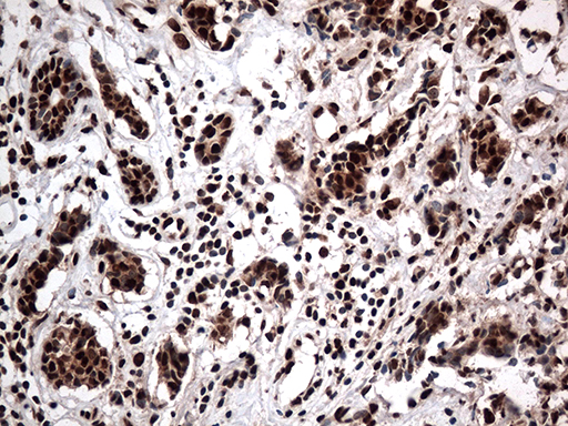 KARS Antibody - Immunohistochemical staining of paraffin-embedded Adenocarcinoma of Human breast tissue tissue using anti-KARS mouse monoclonal antibody. (Heat-induced epitope retrieval by 1mM EDTA in 10mM Tris buffer. (pH8.5) at 120°C for 3 min. (1:500)