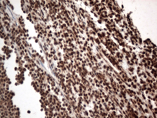KARS Antibody - Immunohistochemical staining of paraffin-embedded Human lymphoma tissue using anti-KARS mouse monoclonal antibody. (Heat-induced epitope retrieval by 1mM EDTA in 10mM Tris buffer. (pH8.5) at 120°C for 3 min. (1:500)