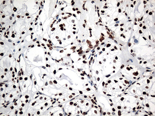 KARS Antibody - Immunohistochemical staining of paraffin-embedded Carcinoma of Human kidney tissue using anti-KARS mouse monoclonal antibody. (Heat-induced epitope retrieval by 1mM EDTA in 10mM Tris buffer. (pH8.5) at 120°C for 3 min. (1:500)