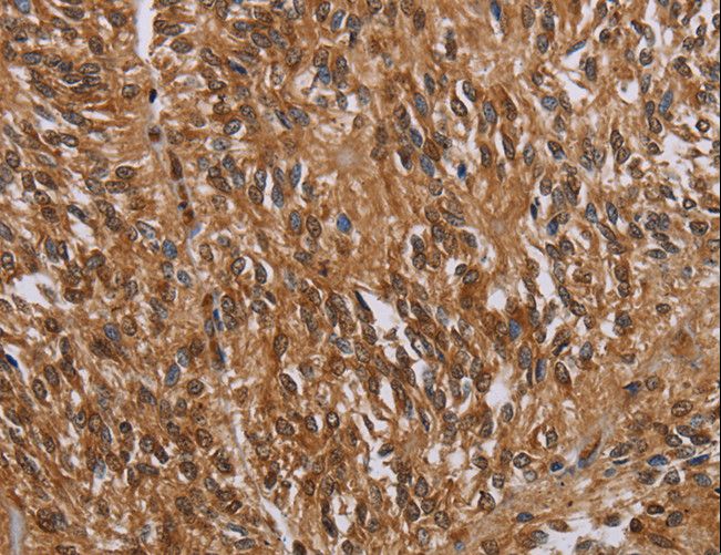 KARS Antibody - Immunohistochemistry of paraffin-embedded Human ovarian cancer using KARS Polyclonal Antibody at dilution of 1:30.