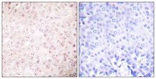 KAT2B / PCAF Antibody - Immunohistochemistry analysis of paraffin-embedded human breast carcinoma tissue, using KAT2B Antibody. The picture on the right is blocked with the synthesized peptide.