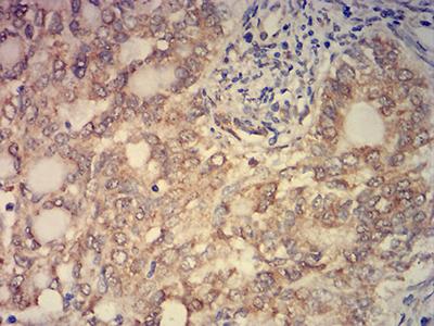 KAT2B / PCAF Antibody - Immunohistochemical analysis of paraffin-embedded cervical cancer tissues using KAT2B mouse mAb with DAB staining.