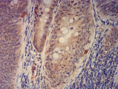 KAT2B / PCAF Antibody - Immunohistochemical analysis of paraffin-embedded rectum cancer tissues using KAT2B mouse mAb with DAB staining.