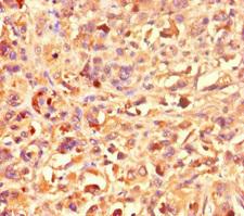 KAT2B / PCAF Antibody - Immunohistochemistry of paraffin-embedded human melanoma cancer at dilution of 1:100
