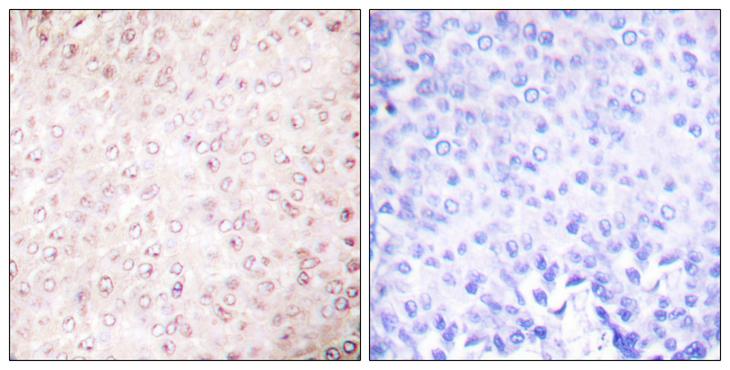 KAT2B / PCAF Antibody - Peptide - + Immunohistochemical analysis of paraffin-embedded human breast carcinoma tissue using P300/CBP Antibody.