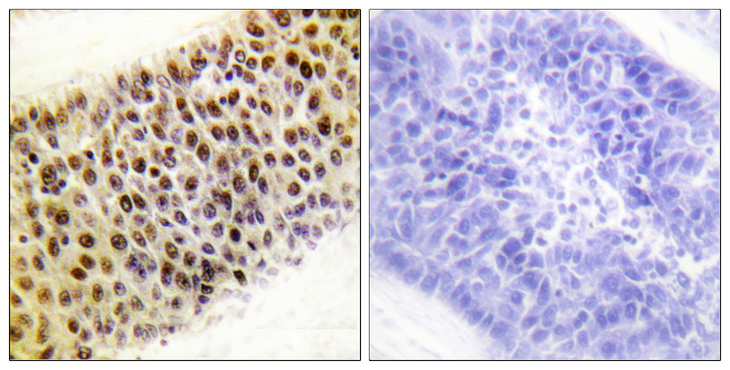 KAT5 / TIP60 Antibody - Immunohistochemistry analysis of paraffin-embedded human liver carcinoma tissue, using TIP60 Antibody. The picture on the right is blocked with the synthesized peptide.