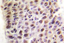 KAT5 / TIP60 Antibody - IHC of TIP60 (G82) pAb in paraffin-embedded human liver carcinoma tissue.