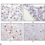 KAT5 / TIP60 Antibody - Immunohistochemistry (IHC) analysis of paraffin-embedded Human Liver Carcinoma (A), recturn carcinoma (B), normal medulla tissue (C) and normal interbrain tissues (D), showing nuclear localization with DAB staining using TIP60 Monoclonal Antibody.