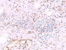 KATNAL1 Antibody - Immunohistochemistry of paraffin-embedded Human cervical cancer tissue  using KATNAL1 Polyclonal Antibody at dilution of 1:95(×200)