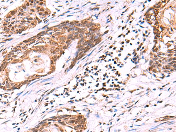 KATNAL1 Antibody - Immunohistochemistry of paraffin-embedded Human esophagus cancer tissue  using KATNAL1 Polyclonal Antibody at dilution of 1:95(×200)