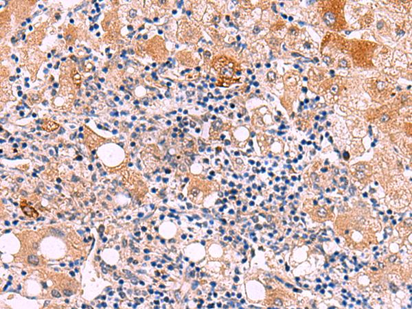 KATNAL1 Antibody - Immunohistochemistry of paraffin-embedded Human liver cancer tissue  using KATNAL1 Polyclonal Antibody at dilution of 1:80(×200)