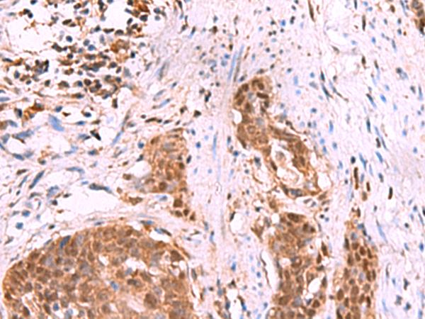 KATNAL1 Antibody - Immunohistochemistry of paraffin-embedded Human esophagus cancer tissue  using KATNAL1 Polyclonal Antibody at dilution of 1:80(×200)