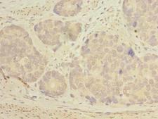 KATNAL2 Antibody - Immunohistochemistry of paraffin-embedded human gastric cancer using antibody at dilution of 1:100.