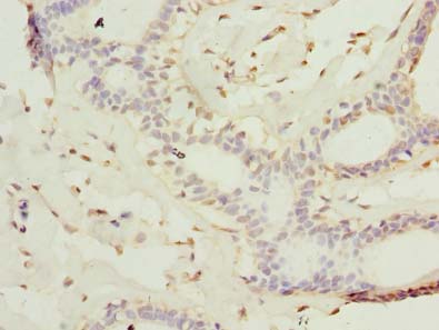KATNAL2 Antibody - Immunohistochemistry of paraffin-embedded human breast cancer using antibody at dilution of 1:100.