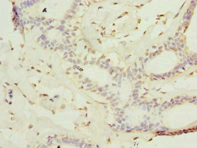 KATNAL2 Antibody - Immunohistochemistry of paraffin-embedded human breast cancer using KATNAL2 Antibody at dilution of 1:100