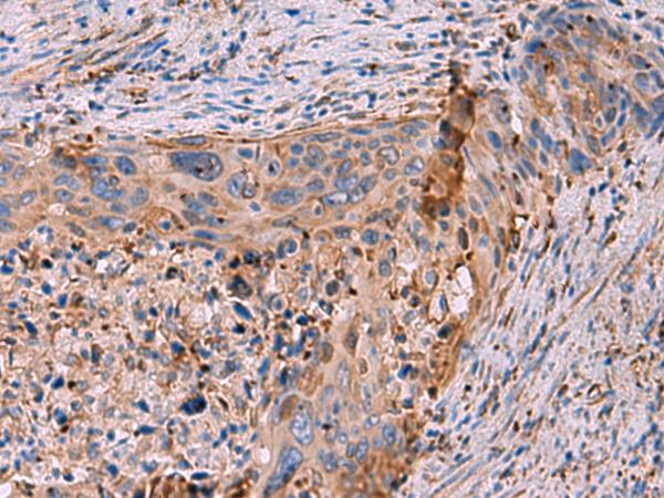KBTBD11 Antibody - Immunohistochemistry of paraffin-embedded Human cervical cancer tissue  using KBTBD11 Polyclonal Antibody at dilution of 1:35(×200)