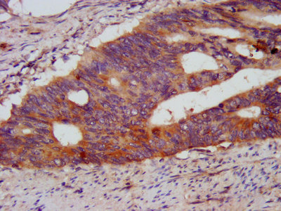 KCMF1 Antibody - Immunohistochemistry image at a dilution of 1:500 and staining in paraffin-embedded human colon cancer performed on a Leica BondTM system. After dewaxing and hydration, antigen retrieval was mediated by high pressure in a citrate buffer (pH 6.0) . Section was blocked with 10% normal goat serum 30min at RT. Then primary antibody (1% BSA) was incubated at 4 °C overnight. The primary is detected by a biotinylated secondary antibody and visualized using an HRP conjugated SP system.