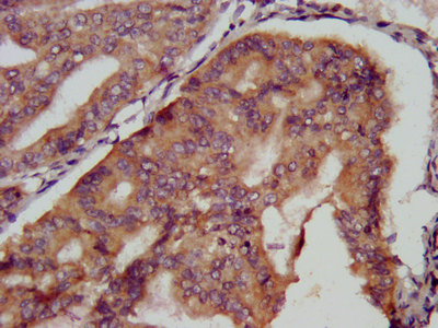 KCMF1 Antibody - Immunohistochemistry image at a dilution of 1:500 and staining in paraffin-embedded human endometrial cancer performed on a Leica BondTM system. After dewaxing and hydration, antigen retrieval was mediated by high pressure in a citrate buffer (pH 6.0) . Section was blocked with 10% normal goat serum 30min at RT. Then primary antibody (1% BSA) was incubated at 4 °C overnight. The primary is detected by a biotinylated secondary antibody and visualized using an HRP conjugated SP system.