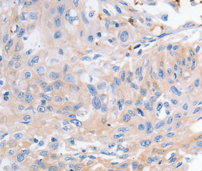 KCNA1 / Kv1.1 Antibody - Immunohistochemistry of paraffin-embedded Human cervical cancer tissue using KCNA1 antibody.