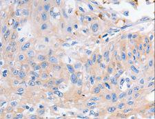 KCNA1 / Kv1.1 Antibody - Immunohistochemistry of paraffin-embedded Human cervical cancer using KCNA1 Polyclonal Antibody at dilution of 1:30.