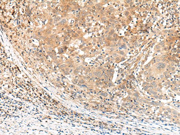 KCNA10 Antibody - Immunohistochemistry of paraffin-embedded Human cervical cancer tissue  using KCNA10 Polyclonal Antibody at dilution of 1:40(×200)