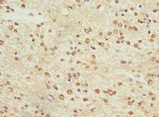 KCNA3 / Kv1.3 Antibody - Immunohistochemistry of paraffin-embedded human glioma cancer at dilution 1:100