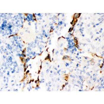 KCNA4 / Kv1.4 Antibody - Kv1.4 antibody IHC-paraffin. IHC(P): Human Lung Cancer Tissue.