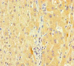 KCNA6 / Kv1.6 Antibody - Immunohistochemistry of paraffin-embedded human liver cancer using KCNA6 Antibody at dilution of 1:100