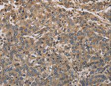 KCNA7 / Kv1.7 Antibody - Immunohistochemistry of paraffin-embedded Human liver cancer using KCNA7 Polyclonal Antibody at dilution of 1:40.