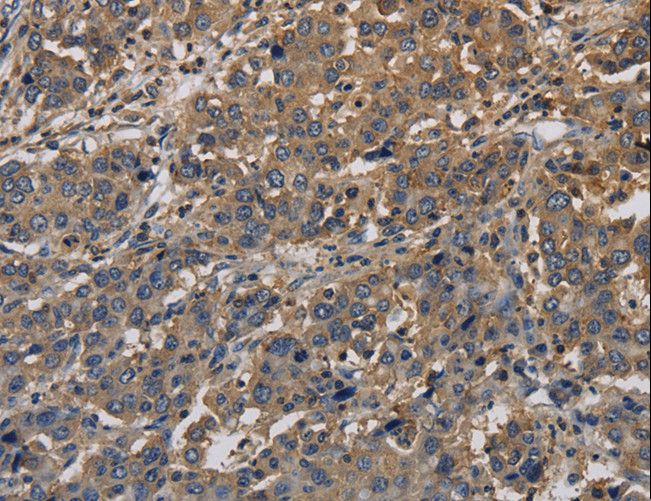 KCNA7 / Kv1.7 Antibody - Immunohistochemistry of paraffin-embedded Human liver cancer using KCNA7 Polyclonal Antibody at dilution of 1:40.