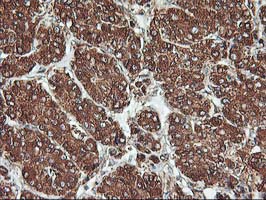 KCNAB1 Antibody - IHC of paraffin-embedded Carcinoma of Human liver tissue using anti-KCNAB1 mouse monoclonal antibody.
