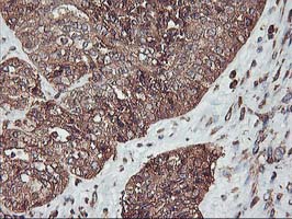 KCNAB1 Antibody - IHC of paraffin-embedded Adenocarcinoma of Human ovary tissue using anti-KCNAB1 mouse monoclonal antibody.