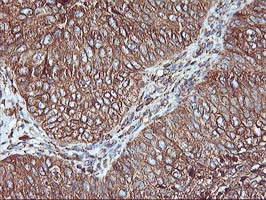 KCNAB1 Antibody - IHC of paraffin-embedded Carcinoma of Human bladder tissue using anti-KCNAB1 mouse monoclonal antibody.