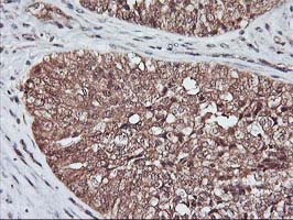 KCNAB1 Antibody - IHC of paraffin-embedded Adenocarcinoma of Human ovary tissue using anti-KCNAB1 mouse monoclonal antibody.