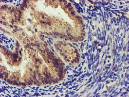 KCNAB1 Antibody - IHC of paraffin-embedded Adenocarcinoma of Human endometrium tissue using anti-KCNAB1 mouse monoclonal antibody. (Heat-induced epitope retrieval by 10mM citric buffer, pH6.0, 120°C for 3min).