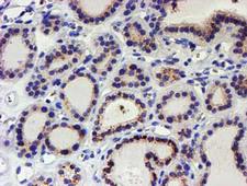 KCNAB1 Antibody - IHC of paraffin-embedded Carcinoma of Human thyroid tissue using anti-KCNAB1 mouse monoclonal antibody.