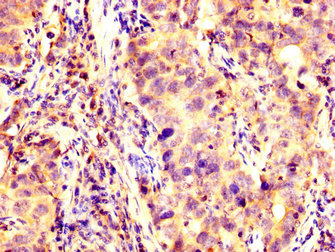 KCNAB1 Antibody - Immunohistochemistry image at a dilution of 1:200 and staining in paraffin-embedded human pancreatic cancer performed on a Leica BondTM system. After dewaxing and hydration, antigen retrieval was mediated by high pressure in a citrate buffer (pH 6.0) . Section was blocked with 10% normal goat serum 30min at RT. Then primary antibody (1% BSA) was incubated at 4 °C overnight. The primary is detected by a biotinylated secondary antibody and visualized using an HRP conjugated SP system.