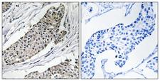 KCNAB3 Antibody - Immunohistochemistry analysis of paraffin-embedded human breast carcinoma tissue, using KCNAB3 Antibody. The picture on the right is blocked with the synthesized peptide.